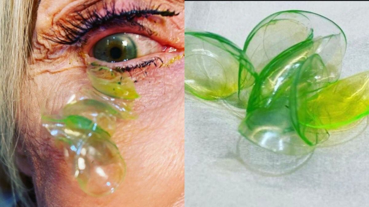 Lentes de contacto, California