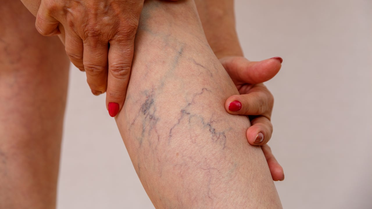 Las várices son un problema muy común que puede llegar a ser molesto.