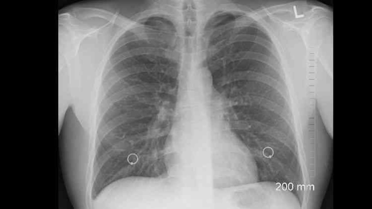 El 20 % de los pacientes con cáncer de pulmón nunca han fumado.