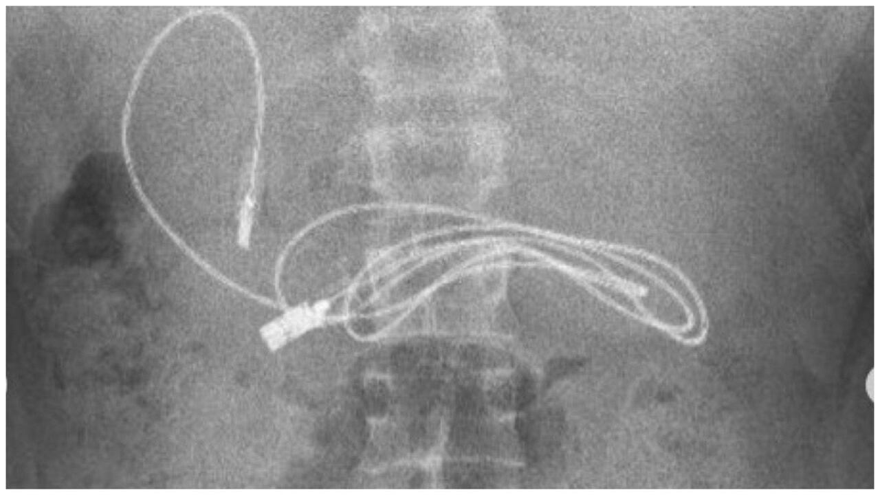 El profesional de la salud tomó la decisión de realzar un procedimiento con endoscopio para poder a través de la boca y el conducto gástrico llegar hasta donde se encontraba objeto.