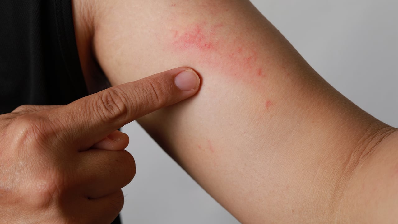 Candidiasis cutánea