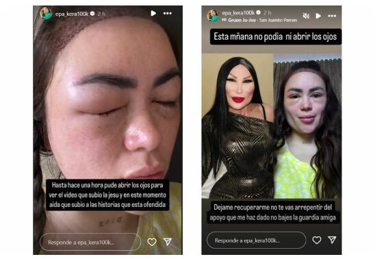 Epa Colombia mostró cómo quedó su rostro luego de implante capilar