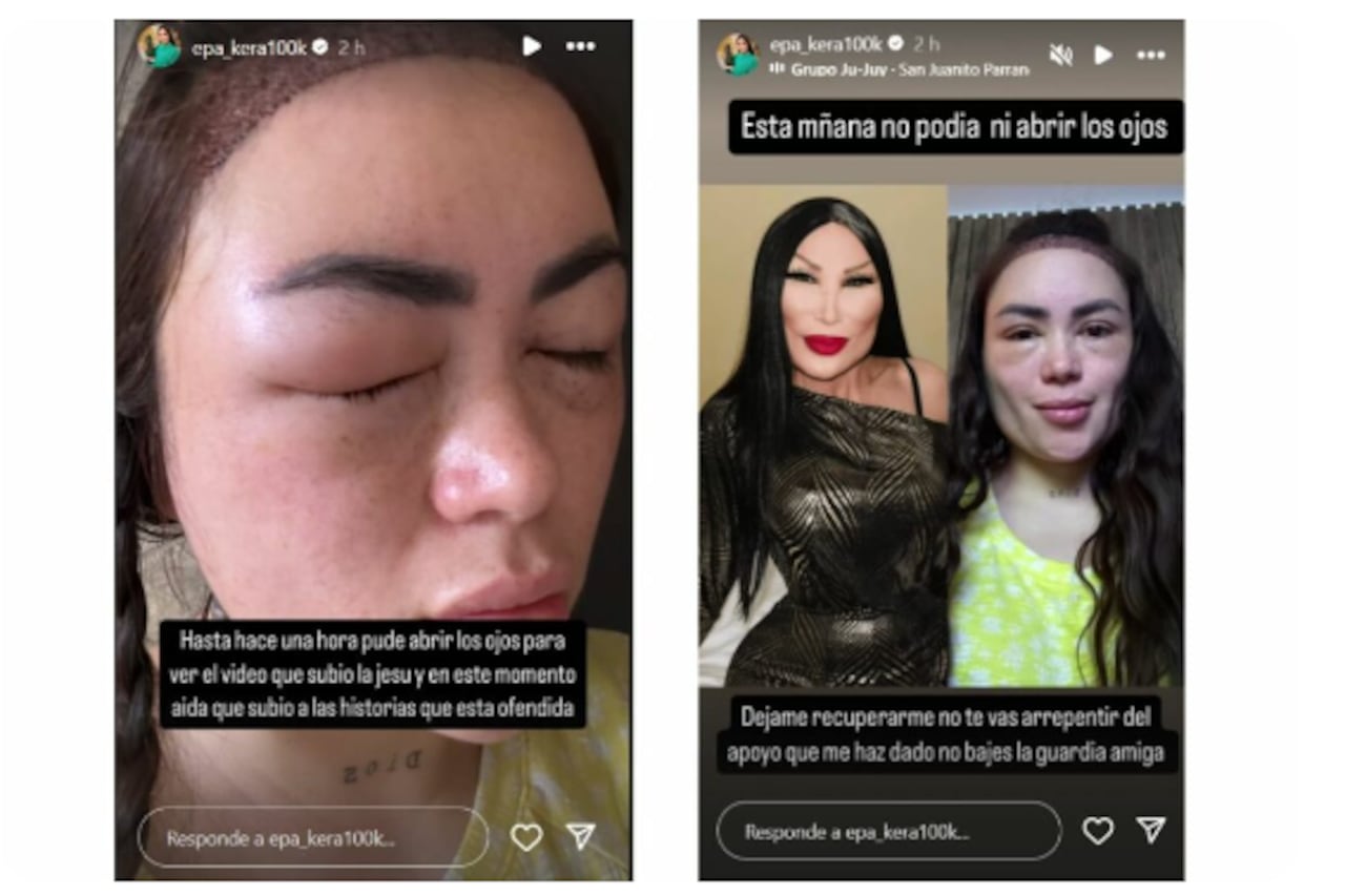 Epa Colombia mostró cómo quedó su rostro luego de implante capilar