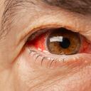 El glaucoma, sigiloso ladrón de la visión.