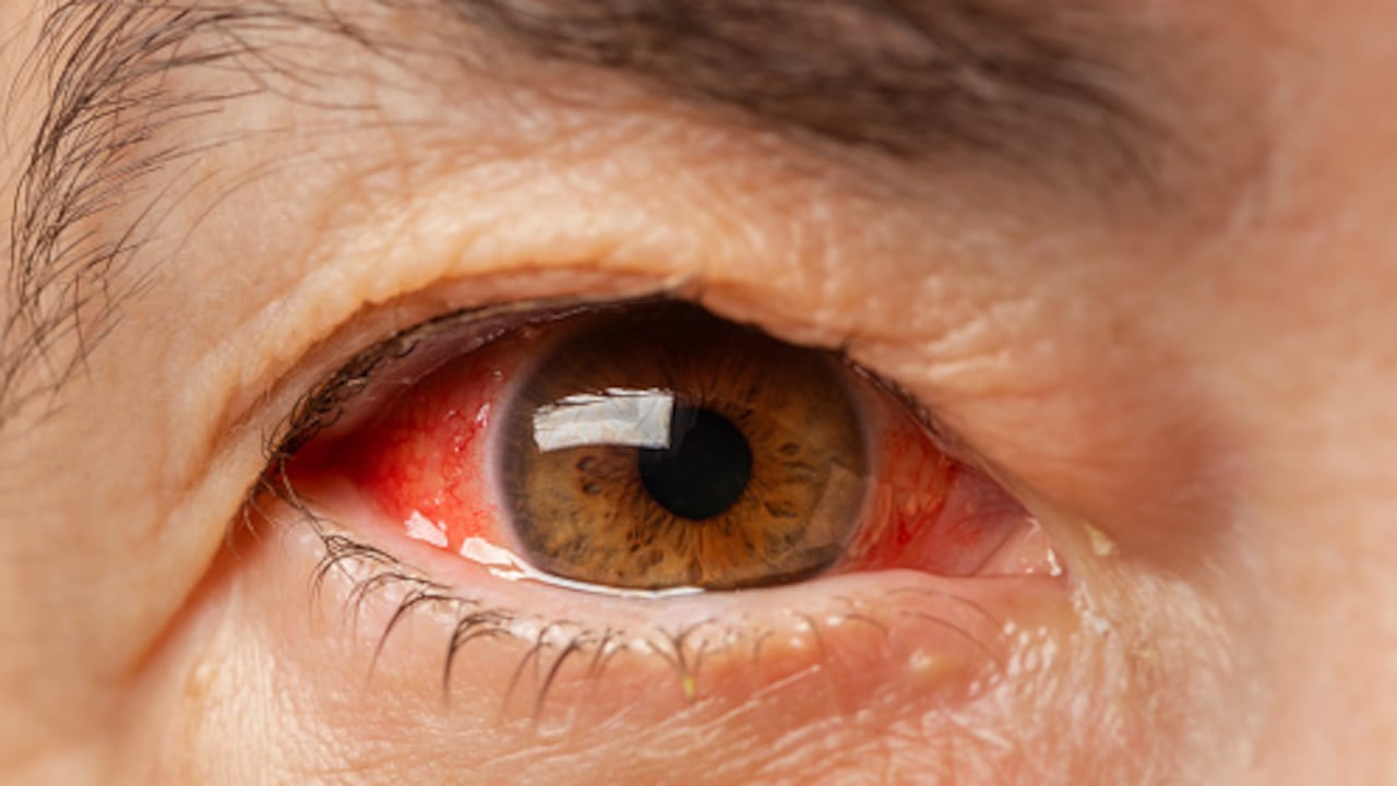 El glaucoma, sigiloso ladrón de la visión.