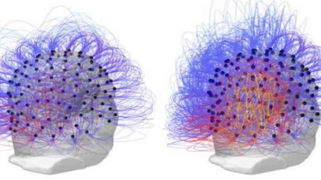 Estos dos escáneres muestran la actividad cerebral del paciente en estado vegetativo antes (izquierda) y después (derecha) del tratamiento. Foto: Corazzol ET AL/BBC Mundo