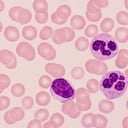 El leucocito de la izquierda con un núcleo ovalado es un linfocito, una importante célula inmunitaria. Los dos leucocitos a la derecha del linfocito son los neutrófilos. Por lo general, tienen un núcleo segmentado o lobulado. Los neutrófilos son excelentes células fagocíticas que engullen partículas o microorganismos dañinos. Los Trombocitos están en la esquina superior derecha, son muy importantes en la trombosis o coagulación de la sangre. Las células teñidas de rosa son eritrocitos, carecen de núcleo, de ahí la palidez central, contienen grandes cantidades de moléculas de hemoglobina y transportan oxígeno. Este es un frotis de sangre normal usando la tinción de Wright.