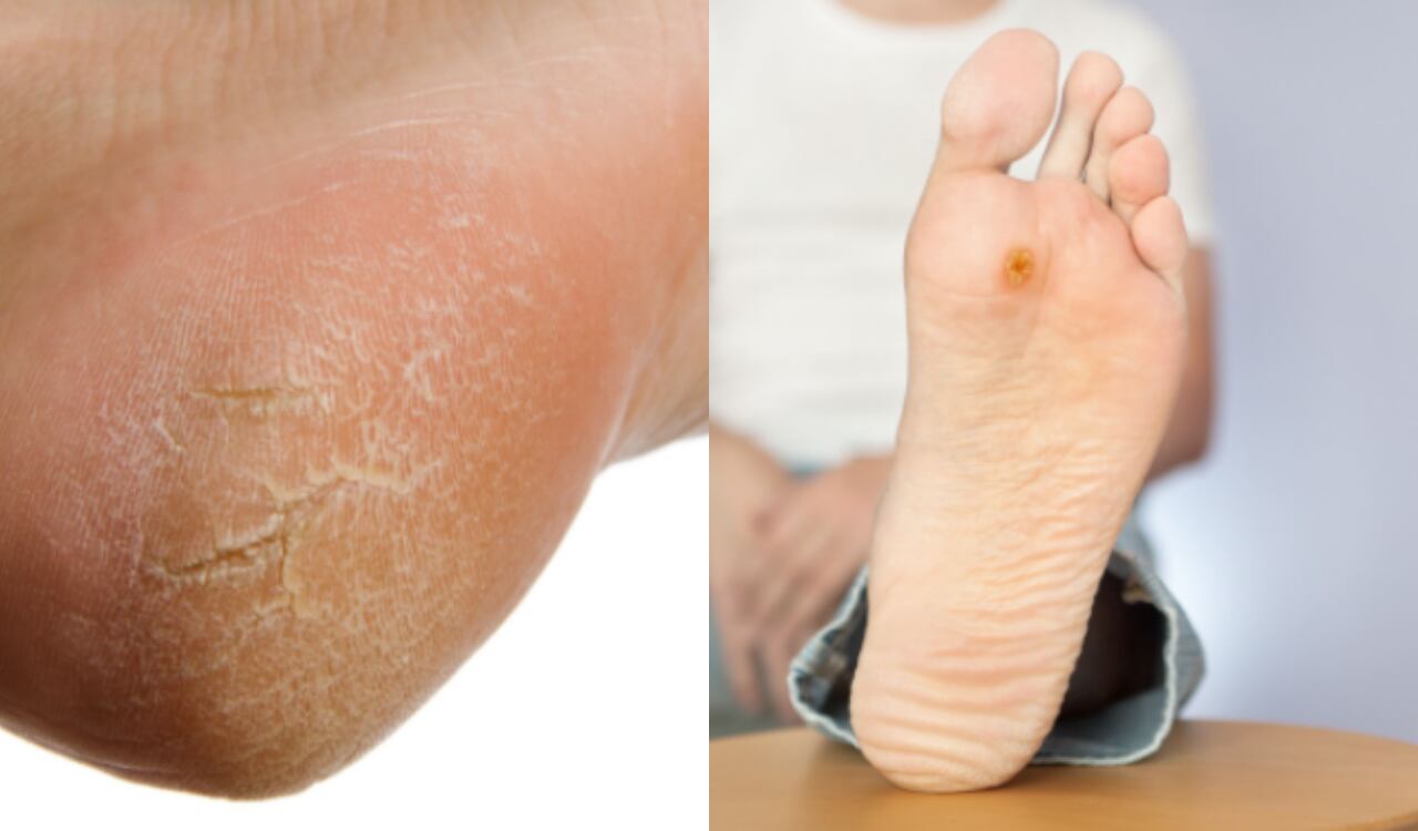 Callos, pies, verrugas