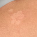 Detalle de hongo en la piel de la espalda