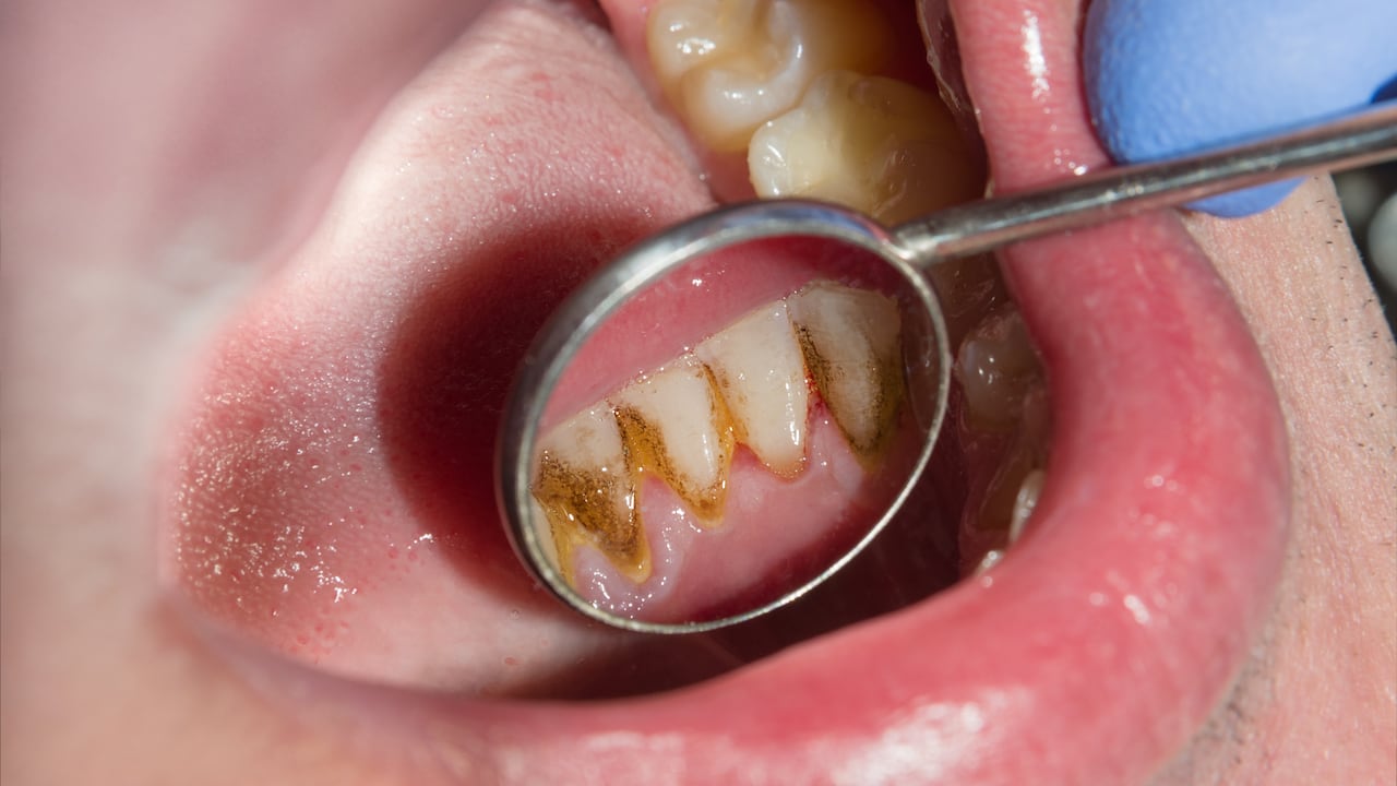 El sarro puede conllevar a muchas complicaciones de salud.