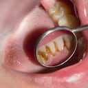 El sarro puede conllevar a muchas complicaciones de salud.