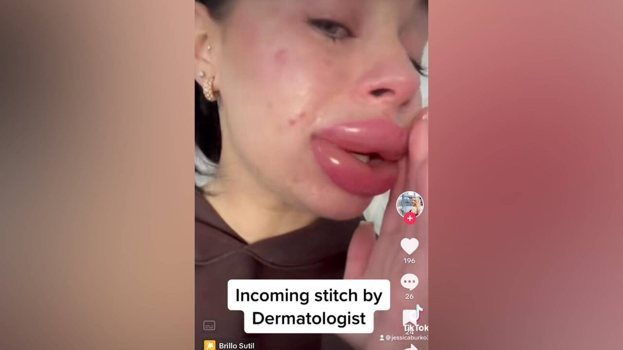 Una mujer revela el efecto de un relleno de labios que recibió gratis “me dolía como un infierno.