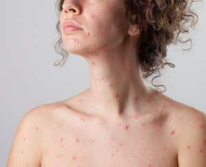 Woman with chickenpox (varicella zoster virus).