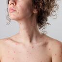 Woman with chickenpox (varicella zoster virus).