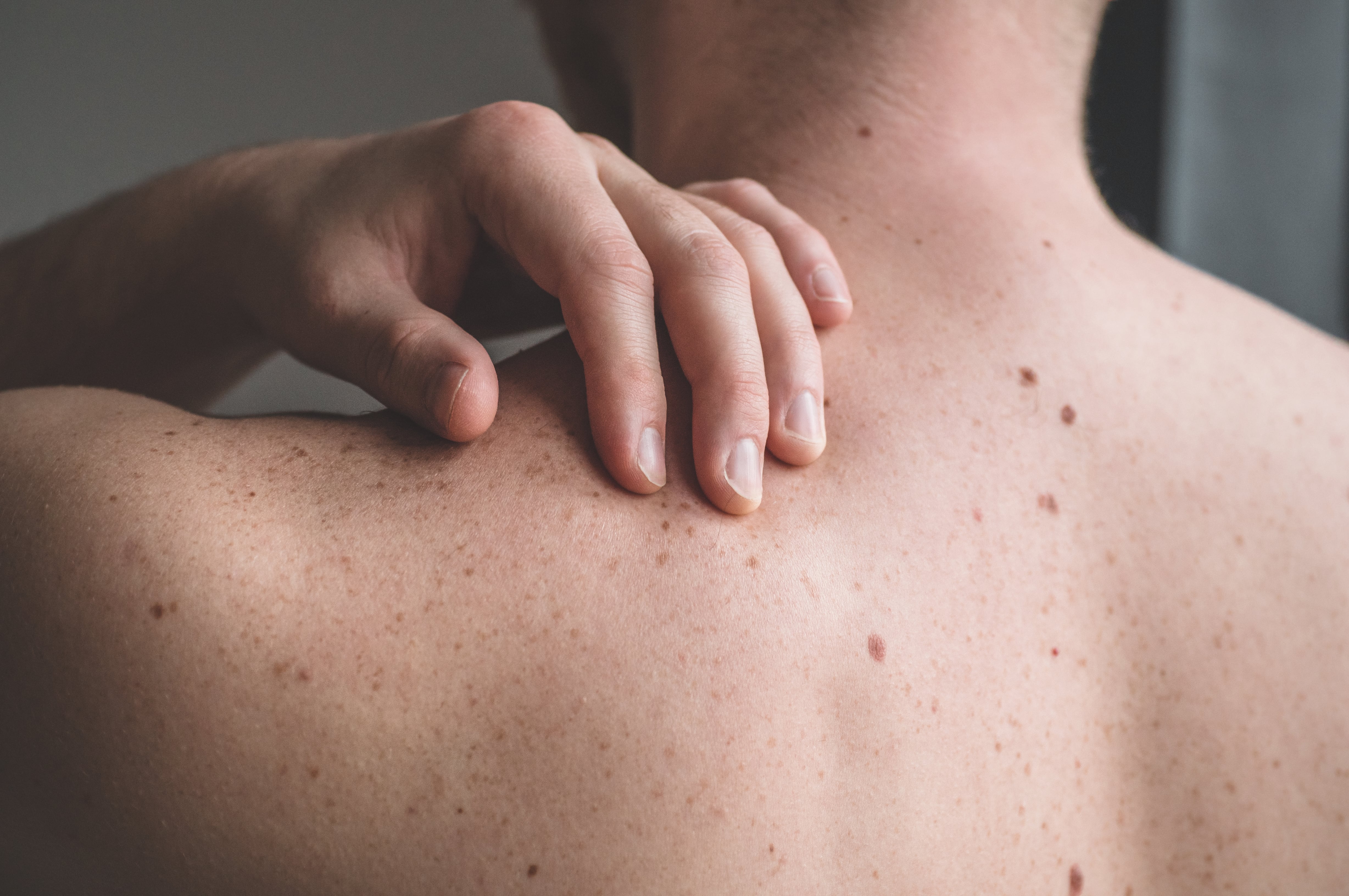 Peluquero alerta sobre extraña mancha en el cuello de su cliente