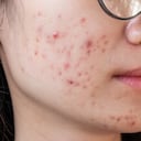 El acné es un trastorno de la piel, según la Clínica Mayo.