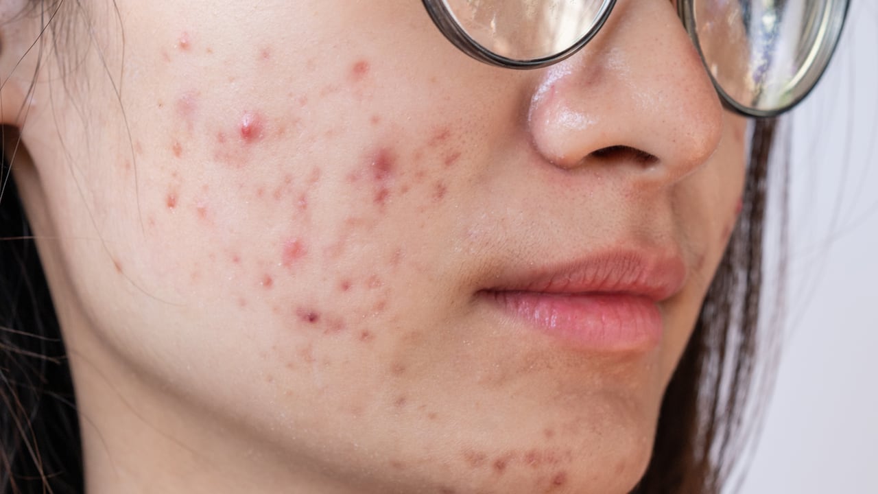 El acné es un trastorno de la piel, según la Clínica Mayo.