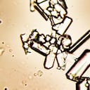 Cristales en la orina