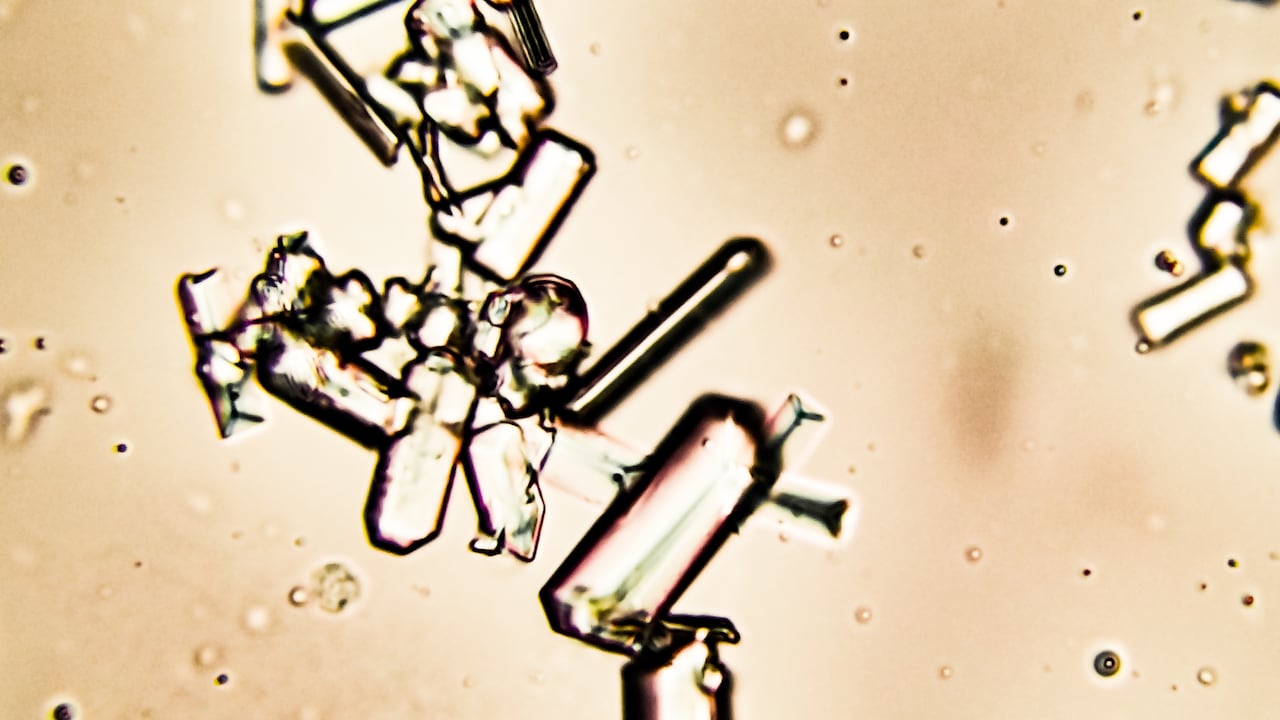 Cristales en la orina