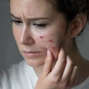 Cualquier persona puede sufrir de acné.