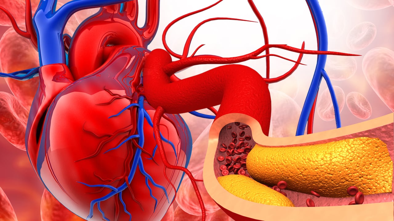 El colesterol que se acumula en la sangre puede generar placas en las arterias y generar afecciones cardiovasculares. Foto: Getty Images.