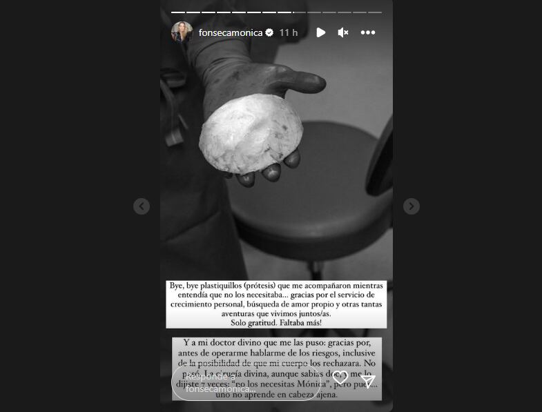 Esos fueron los implantes que le retiraron a Mónica Fonseca