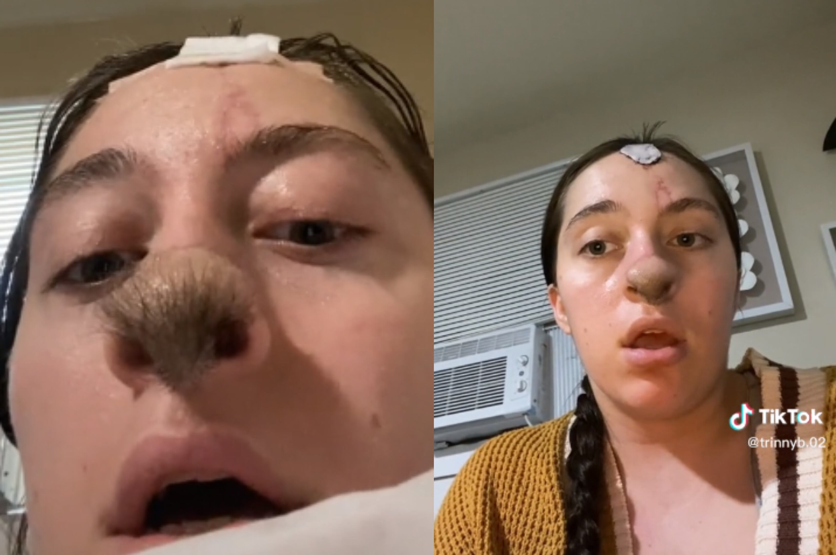 Tras el ataque, la nariz de Trinity Rowles fue reconstruida con injertos de cuero cabelludo.