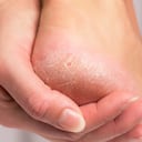 Tacón de mujer con piel endurecida.