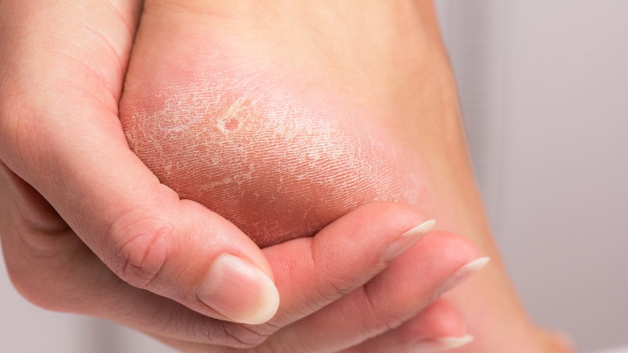 La resequedad en los pies puede causar el endurecimiento de algunas zonas de la piel en dichas extremidades.