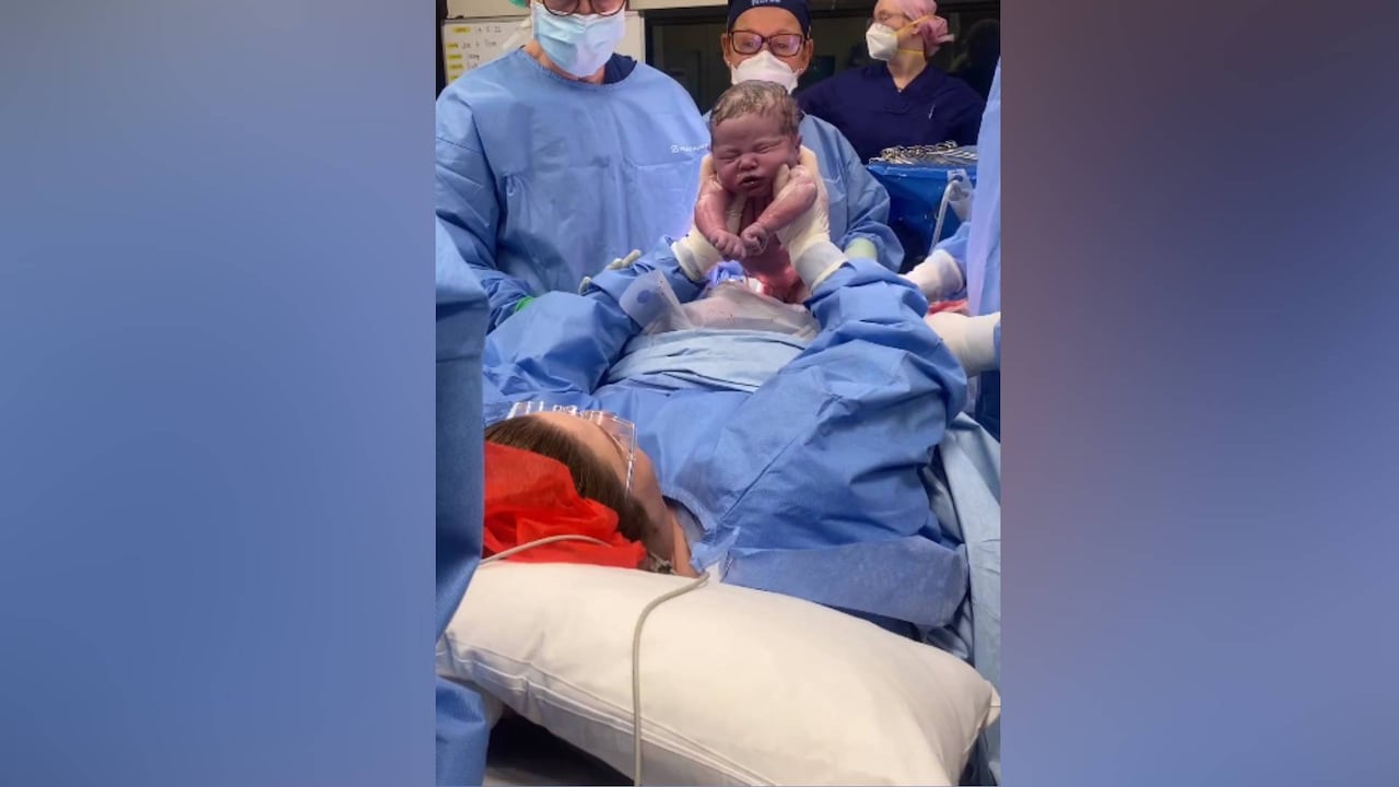 Este tipo de extracción del bebé se puede realizar cuando el nacimiento se da por cesárea.