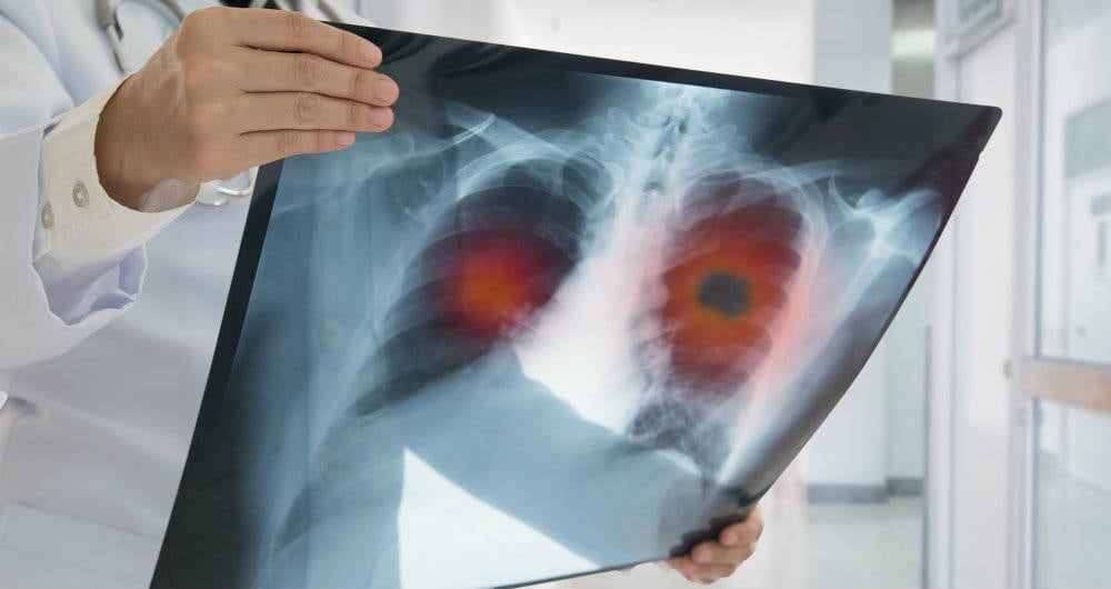 El cáncer de pulmón es la causa más frecuente de muerte por cáncer. 