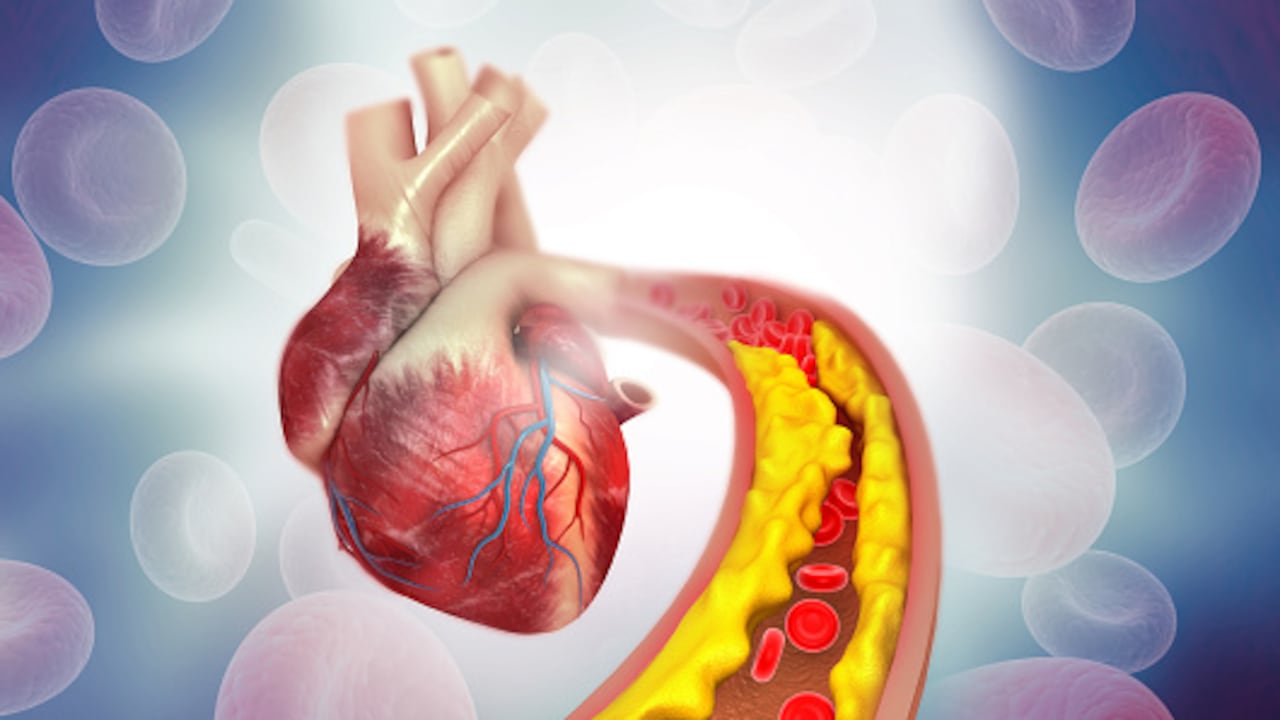 Cholesterol plaque in artery with Human heart anatomy. 3d illustration