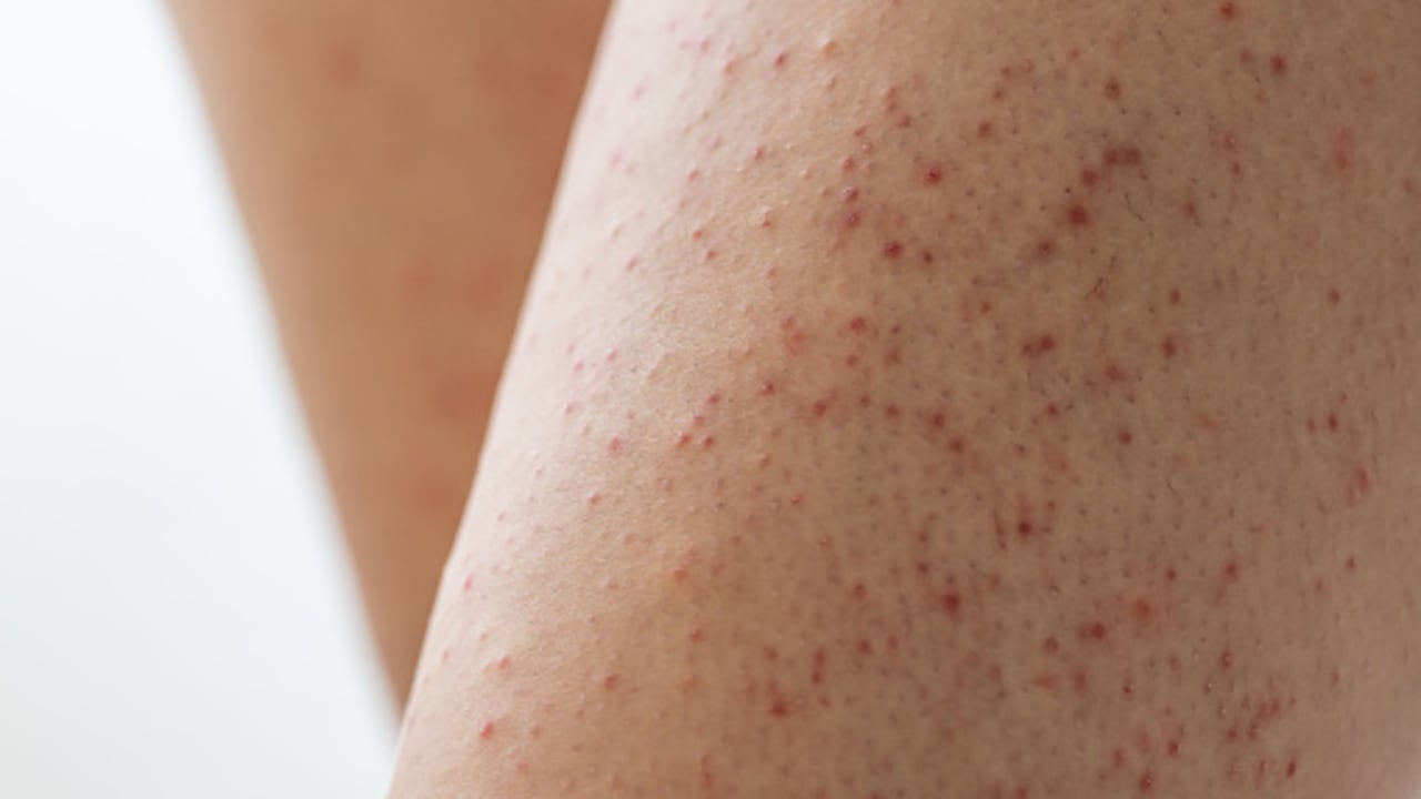 Queratosis pilaris afecta en la piel.