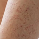 Queratosis pilaris afecta en la piel.