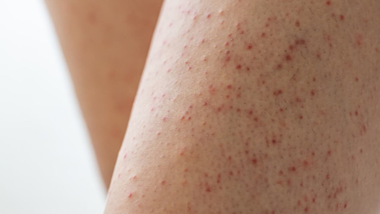 Queratosis pilaris afecta en la piel.