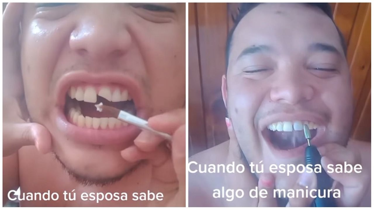Emiliano Chuedy es un creador de contenido que sufrió un accidente dental, el hombre se partió uno de sus dientes delanteros.