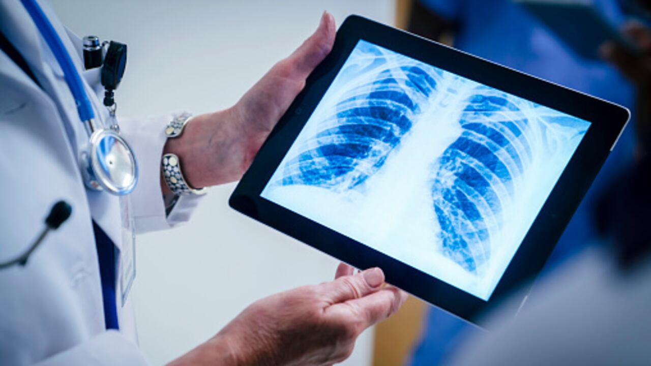 En el caso de niños, los médicos recurren a una radiografía de tórax y una espirometría, para encontrar la causa de la tos crónica.