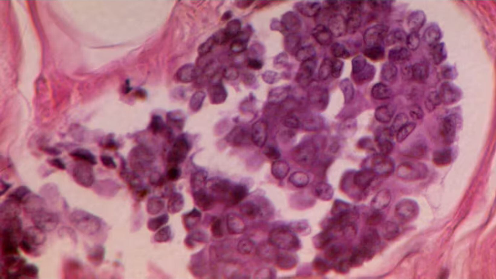 La nueva prueba utiliza la secuenciación del genoma completo para identificar las mutaciones en el ADN tumoral de un paciente
