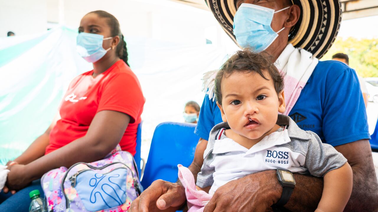 Niño con labio fisurado.