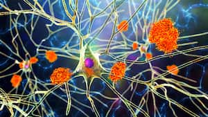 Alzheimer's disease. Illustration of amyloid plaques amongst neurons and neurofibrillary tangles inside neurons. Amyloid plaques are characteristic features of Alzheimer's disease. They lead to degeneration of the affected neurons, which are destroyed through the activity of microglia cells.