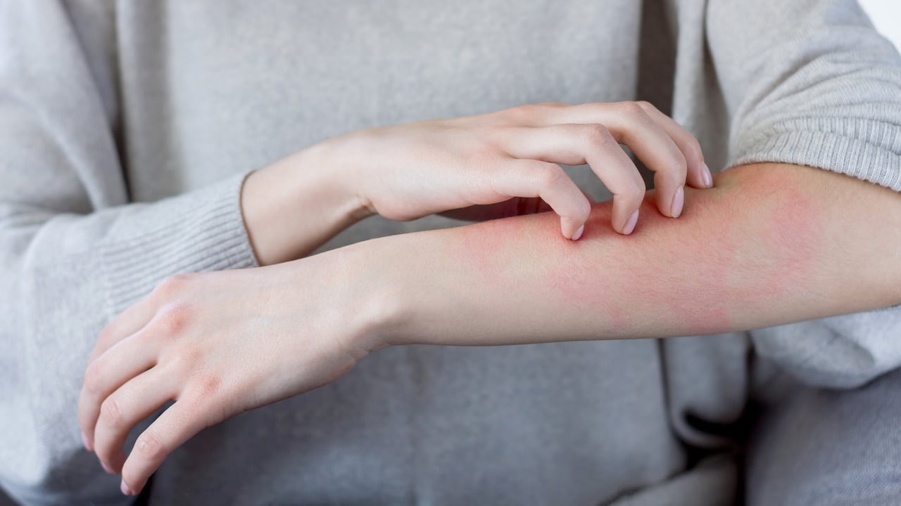 La psoriasis por lo general se presenta entre los 15 y 35 años de edad, o a medida que las personas envejecen.