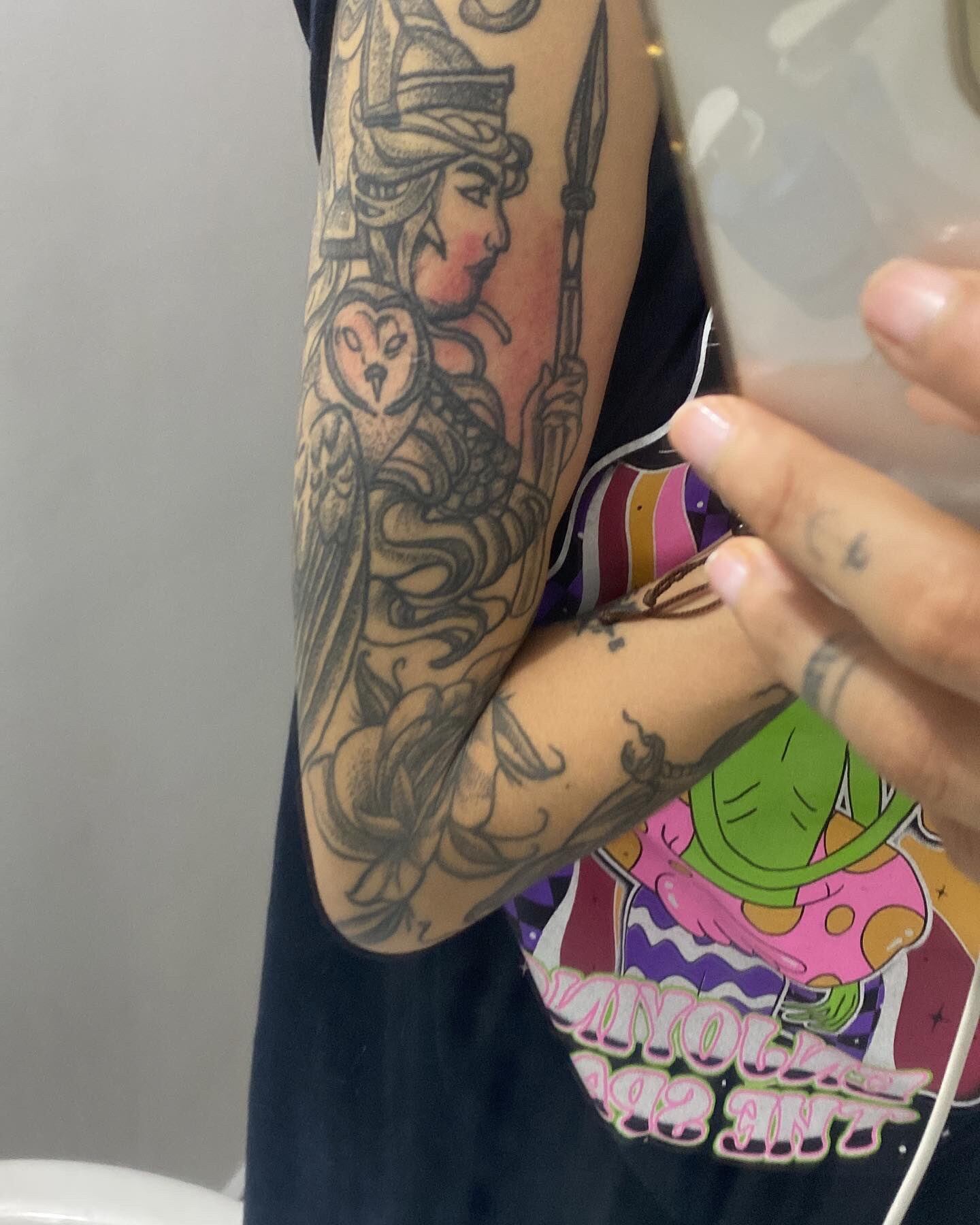 Esta fue la foto que publicó Pola Varela de su brazo. Afirma que Crisitina Amórtegui la habría lesionado.