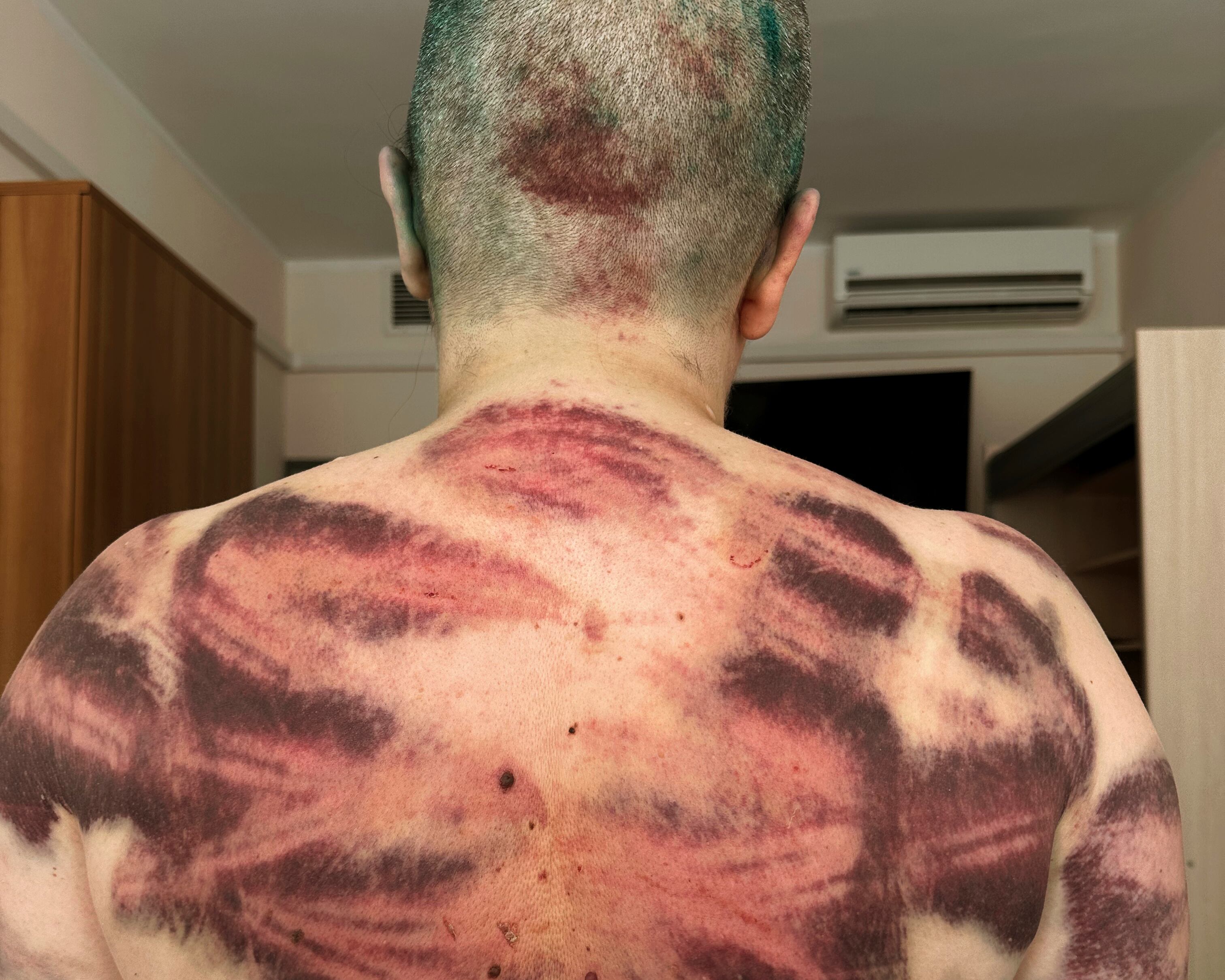 La periodista Elena Milashina, mostró parte de las heridas derivadas del ataque en su contra.