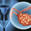 Este tipo de enfermedad inicia en los órganos reproductores femeninos que producen los óvulos.