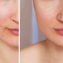 Conozca si el jugo de limón es apropiado para el acné