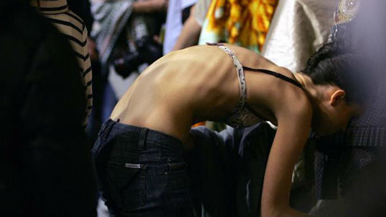 Las dietas ricas en calorías para pacientes con anorexia nerviosa acortan su hospitalización