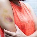 Los hematomas generalmente se producen por golpes, pero también pueden obedecer a otras causas.