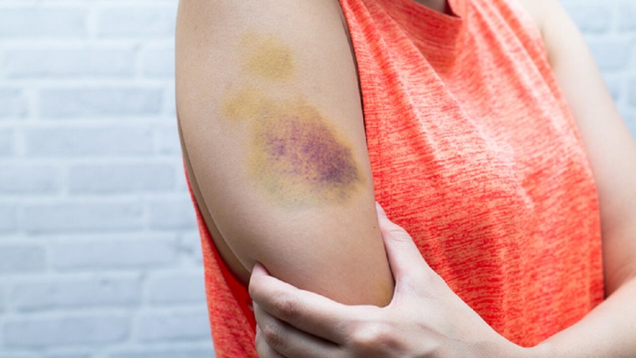 Los hematomas generalmente se producen por golpes, pero también pueden obedecer a otras causas.