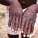 Viruela del Mono. Imagen de referencia.