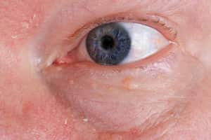 El herpes ocular es una enfermedad vírica que se desarrolla en los ojos.